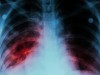 Signs of ingested TB