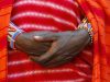 Stigma around Hepatitis B infection