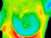 Can Thermal Imaging Detect Breast Cancer?