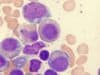Queen’s University Belfast Awarded Research Grant to Improve Bone Marrow Cancer Treatment