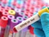 Covid-19: TAPb accelerates clinical trials by providing patient samples