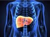 Chronic inflammatory liver disease treatment