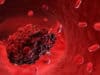 Blood clots and lung injuries found patients who have died of Covid-19