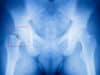 Hip fracture risk linked to nanoscale bone inflexibility