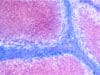 New study on Liver Cirrhosis