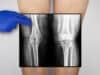 Cartilage matrix as natural biomaterial for cartilage regeneration