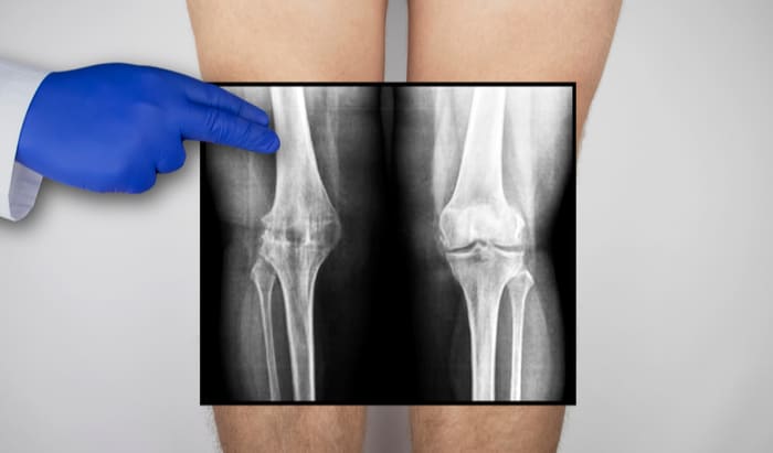 cartilage