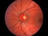 Gene therapy: glaucoma and dementia