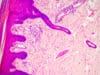 New factor in the development of psoriasis
