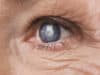 Alzheimer’s and cataract surgery