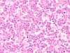 New therapy approach anaplastic large cell lymphoma
