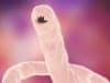 Oral hookworm vaccine could save millions around the world