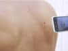 Patient-led surveillance shows promise for melanoma care