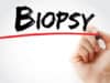 Prostate cancer: “liquid biopsies”