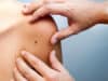 New skin microbiopsy device developed