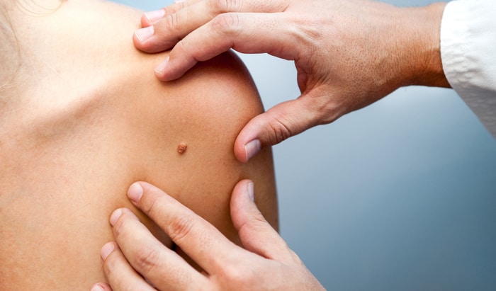 microbiopsy