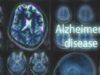 Single brain scan can diagnose Alzheimer’s disease