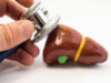 Patients at high risk of liver failure and bile duct damage