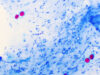 How globalisation could be making human parasites more virulent