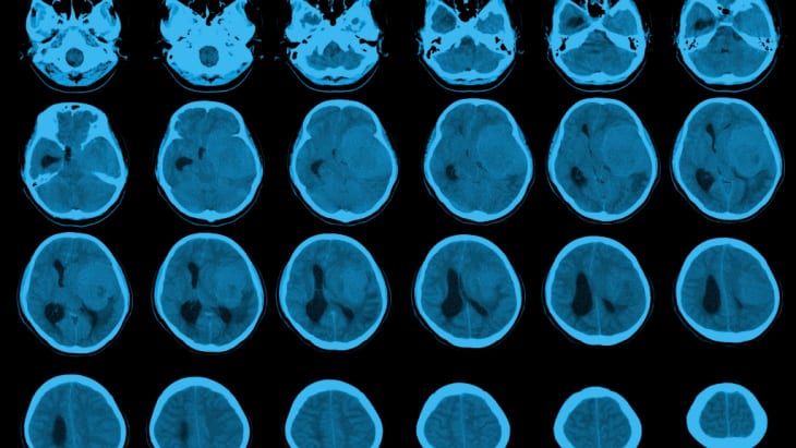 deadly brain tumour