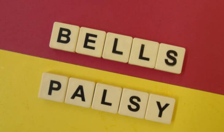 Bell's palsy