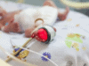 Steroids helping babies come off ventilators