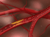 Atherosclerosis intervention in adolescence