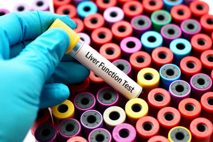 Non-Alcoholic Fatty Liver Disease