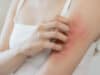 Fewer cases of melanoma among people with atopy