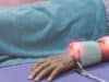 Study reveals inequities in treatment and recovery from stroke