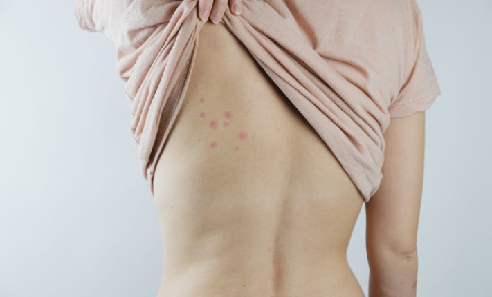 bedbug infestation