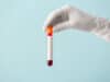 Blood tests for diagnosing dementia a step closer for UK