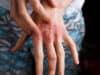 Atopic dermatitis: viruses discovered as new therapy option