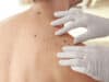 Potential genetic screening for aggressive melanoma