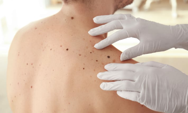 aggressive melanoma