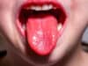 Scarlet fever and streptococcal infections – What are they?