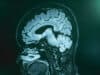 Bruce Willis’s diagnosis sees 2023 web spike in interest in rare dementia