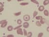 Sickle cell patients to benefit from £1.5m technology investment from NHS England