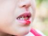 How to save a knocked out tooth