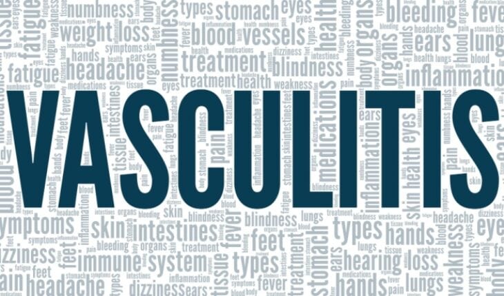 vasculitis