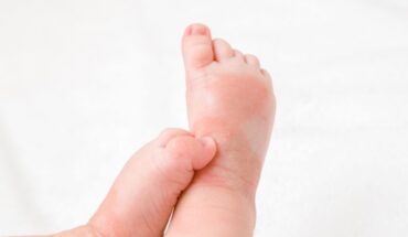 childhood eczema
