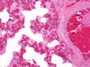 Venous thromboembolism in children