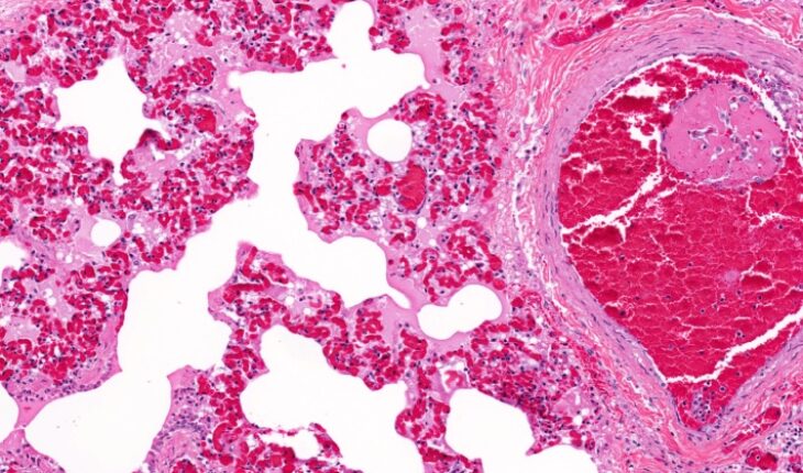 thromboembolism in children